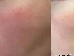 晒伤后皮肤发红怎么修复？1文教会你